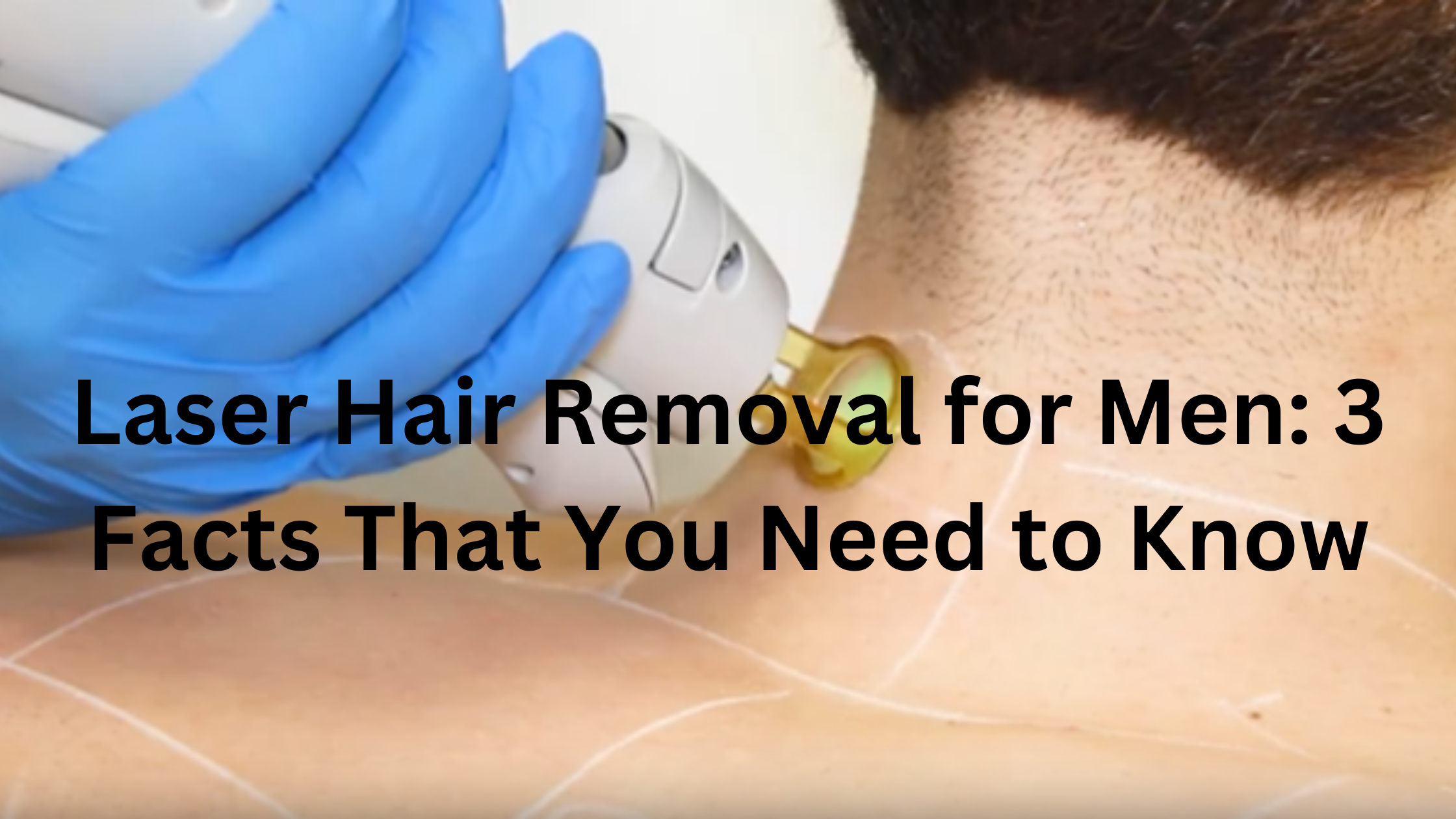 Laser Hair Removal for men