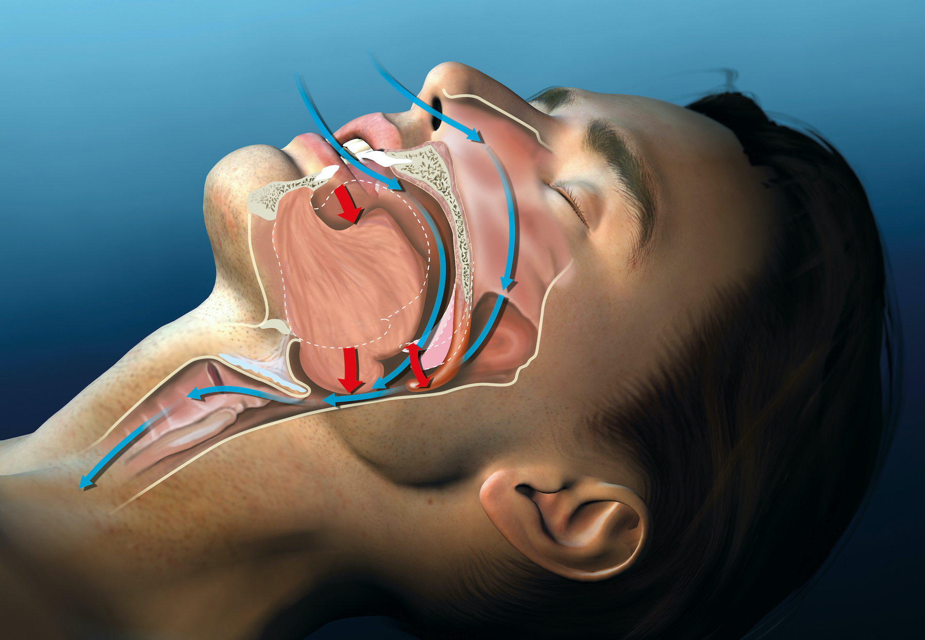 sleep apnea treatment in houston
