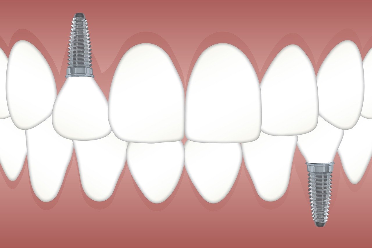 full dental implants